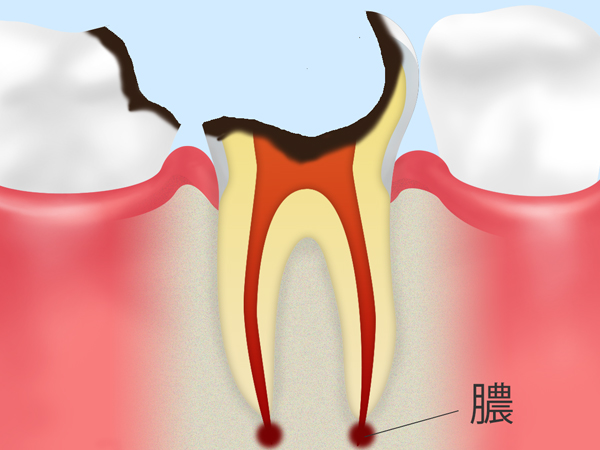 神経が死んでしまった虫歯