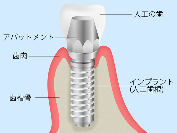 フィクスチャー（歯根部）